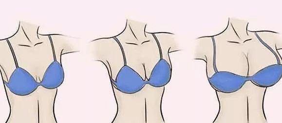 乳房下垂要怎么矫正