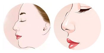 鼻基底凹陷怎么改善？