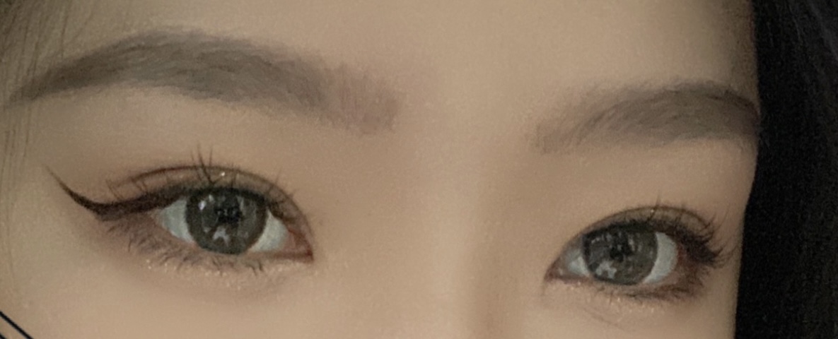 济南双眼皮医院怎么治疗上眼睑脂肪厚？