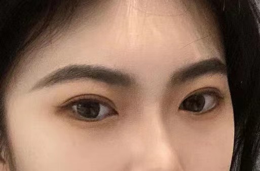 济南双眼皮医院眼综合里的翘睫术是什么？