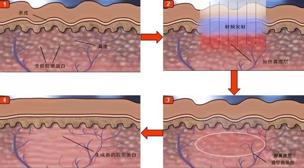 说到射频，其实它是高频交流变化电磁波的一种简称，它通过给皮肤的组织进行加热，且在可控的情况下影响皮肤的结构变化，其实也包括胶原的长度，从而也使得胶原蛋白再生。可以对抗皮肤的老化治疗，起到一个比较有效的作用。