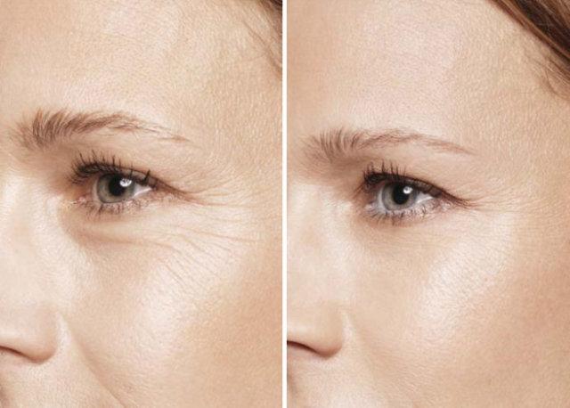 随着年龄的衰老，眼部周围皮肤的胶原蛋白每年也以肉眼可见的速度开始减少，缺乏支撑的皮肤逐渐就会出现皱纹，凹陷，甚至沟壑，皮肤质地也从Q弹变得越来越松垮，再加上不适当的日晒，日复一日的化妆，各种原因引起的过敏红肿，更加雪上加霜，加速了眼周皮肤的老化。