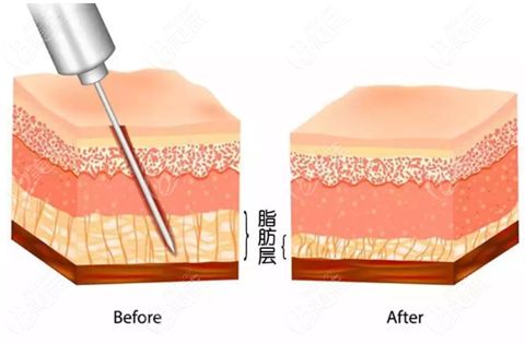 想要术后效果更好，术后良好的护理至关重要，那么抽脂后有什么注意事项呢？