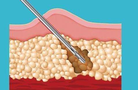 1.首先，吸脂只针对皮下脂肪