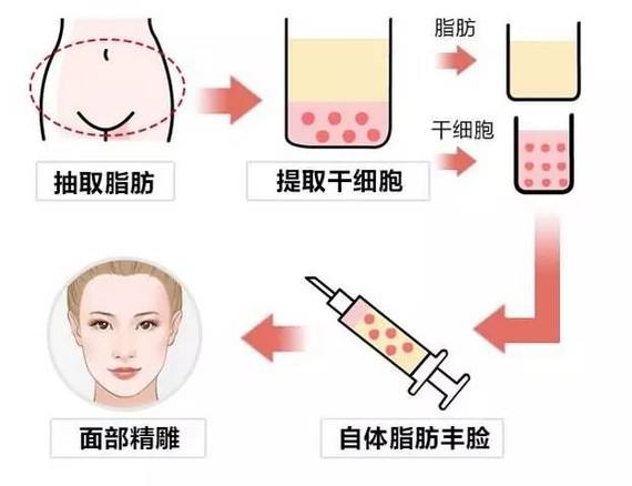 面部扁平凹陷，不仅会加重年龄感，还会显苦相，有些甚至看着显得过于严肃，不好相处，很多求美者会选择脂肪填充来改善，达到饱满减龄的效果。不过在面诊过程中发现，有些求美者担心做完自体脂肪丰面后脸部会出现下垂的情况。