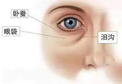 眼袋就是位于眼睛下方的突起，实际上是眼睛下方的眶隔脂肪组织。是随着人年龄增大、眶隔松弛，眶内的脂肪向外突出所形成的。