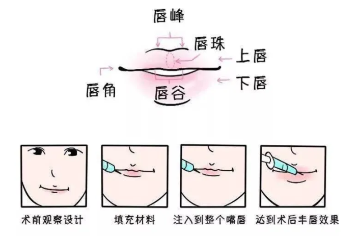 1.控制嘴唇的体积。注射的物质量可以控制，因此医生可以更好地控制产生多少唇部体积。