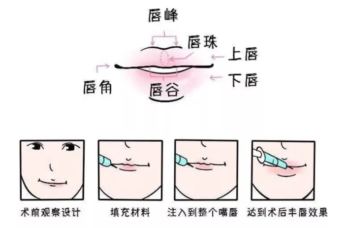 1、玻尿酸丰唇能保持多久?