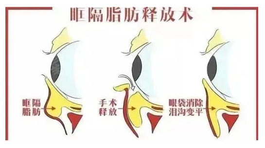 现在有很多人都存在眼袋的困扰，那么有一些爱美人士就想要通过一些方式把眼袋去除，而目前去眼袋的方式有激光和手术两种方式，而选择哪一种也是要根据实际的情况来选择的。