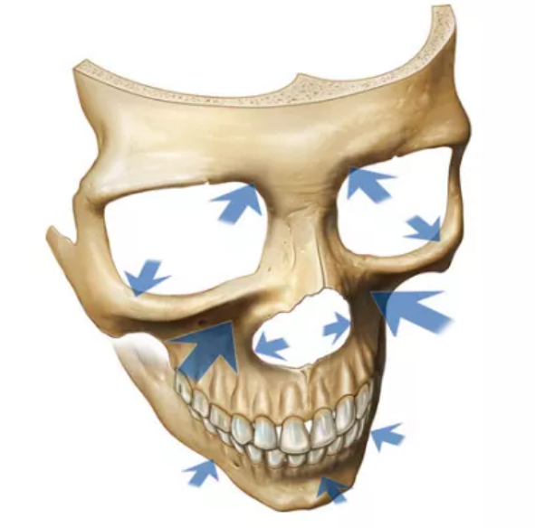 我们把中面部部位定义为颧骨+上颌部位，其老化表现所包含的特征为眼袋、颧袋、鼻唇沟以及上口周所呈现的问题。其形成原因主要为上颌骨的骨组织不充足/流失，导致韧带附着点发生变化，再加上眼轮匝肌和肌下脂肪的松弛+萎缩，组织相互挤压致使产生空间/褶皱。