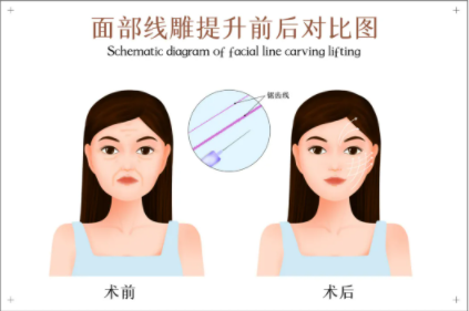 线雕的效果跟面部松垂状况息息相关，理论上，做线雕没有年龄的限制，20岁、50岁都能做，只要成年人就可以。然而事实上，这两年说反馈线雕“不靠谱”的求美者也越来越多，这又是为什么？主要有以下原因：