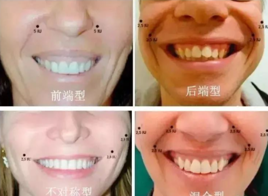 “露龈笑”（gummy smile/gingival smile），指的是笑的时候，露出范围超过2mm粉红色的牙龈。