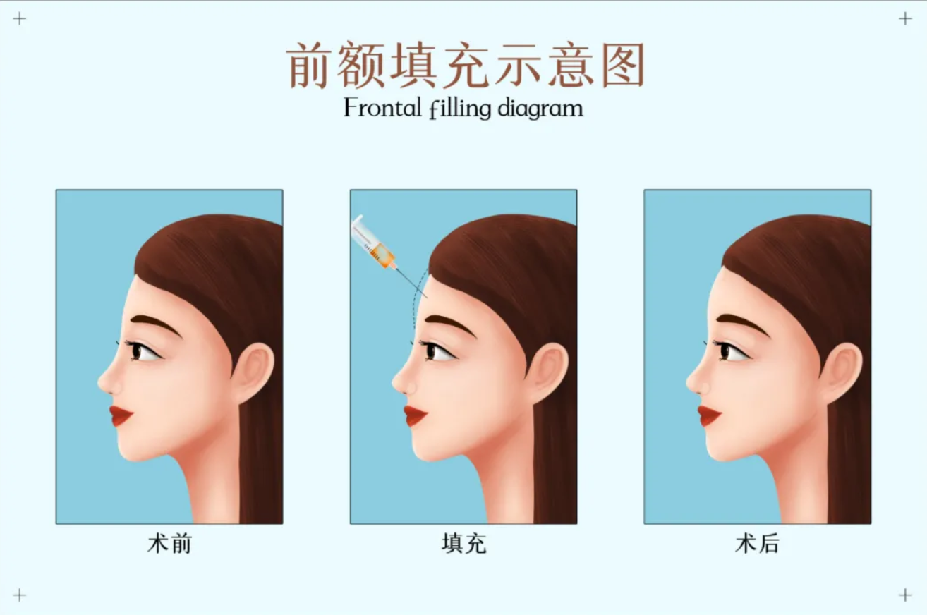 每个人的审美观不同，部分年轻的宝宝们会追求夸张些的效果，要求填充效果更饱满些。但更多的宝宝们追求的是自然风，这就决定了如果想要效果自然不夸张、避免“充气感”。