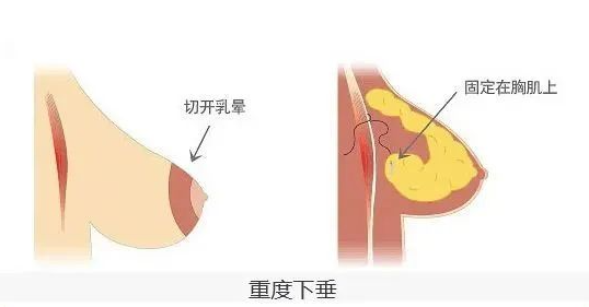 乳房下垂如何来整形？