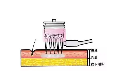 涂抹水光、无针水光和注射水光有什么区别？