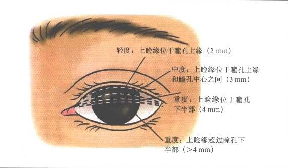 上睑下垂通俗来说就是上眼皮部分或全部抬不起来。眼皮之所以能提得起放得下，是提上睑肌及眼轮肌相互作用的结果，当提上睑肌因为某些原因缺乏力量时，就没有办法将眼皮提起，也就形成了上睑下垂。上睑下垂可能发生在双眼或单侧眼，会给人睡眼惺忪、无精打采疲惫的状态。