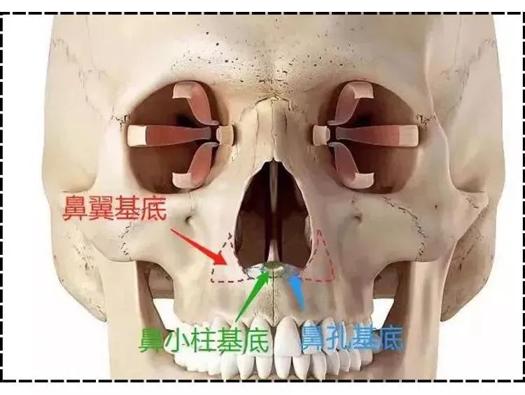 1、注射填充鼻基底