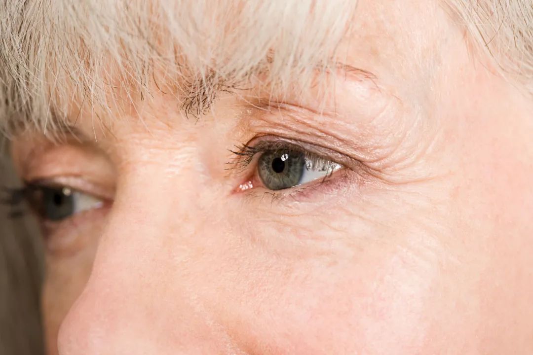 眼部衰老问题怎么解决（一）？