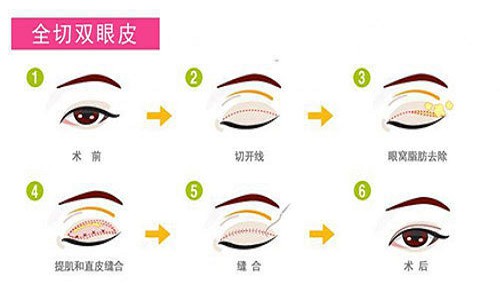 提眉术和全切双眼皮哪个效果好?