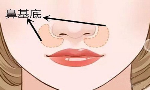 做完鼻整形恢复期伤口为什么会偶尔发痒？