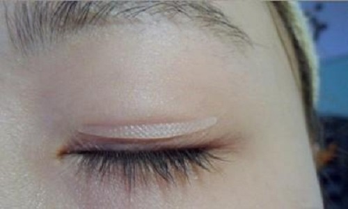 双眼皮+开眼角手术后如何缩短消肿时间？