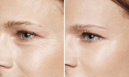 眼周的皱纹如何改善？