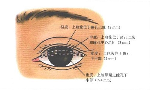 有上睑下垂怎么办？