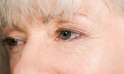 老年性眼睑松弛综合征是什么？